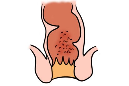肛管鳞状细胞癌图片