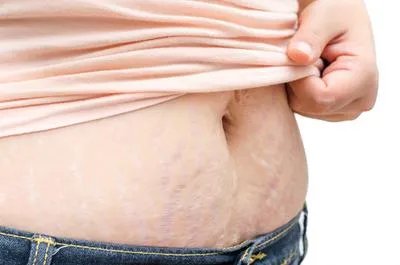 产后怎样可以消除妊娠纹