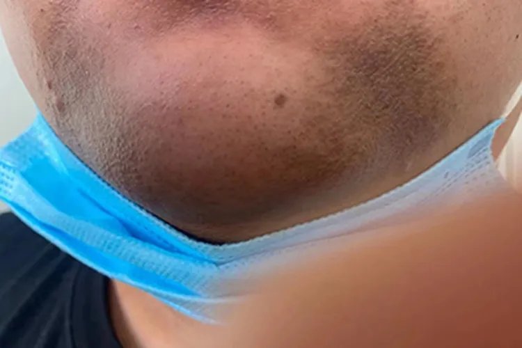 皮肤黑变病症状图片