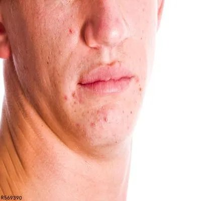 狂犬病的预防方法有哪些 狂犬病是什么原因引起的