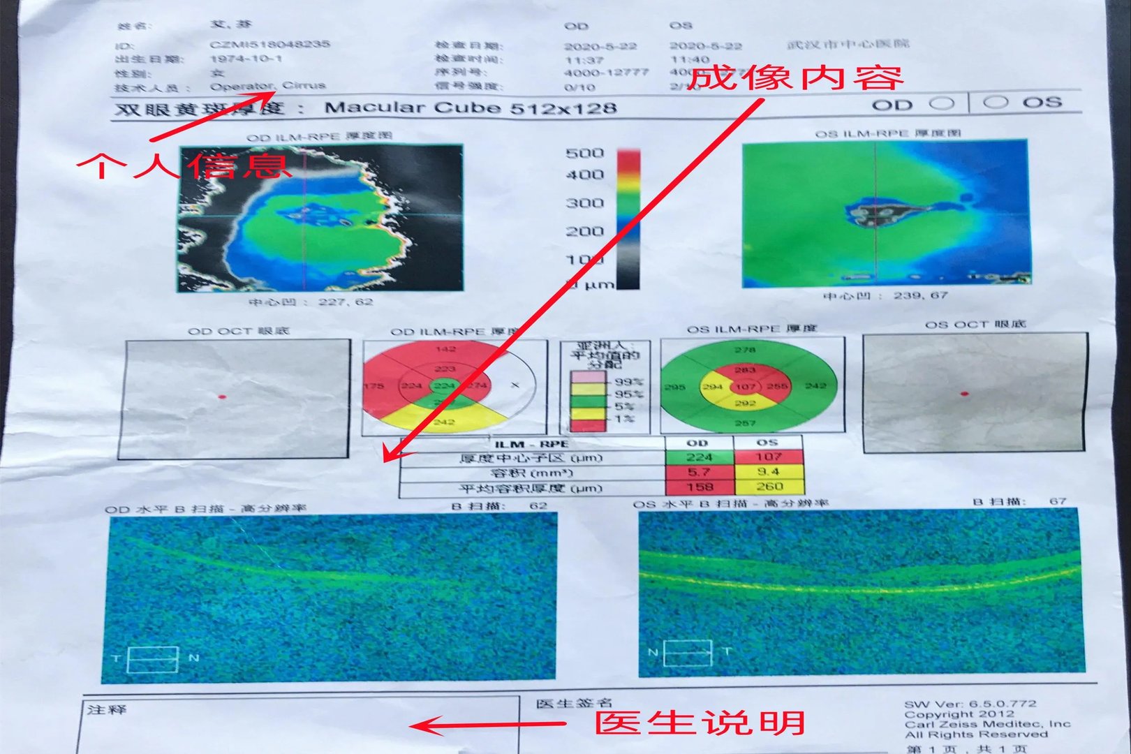 正常的眼科OCT报告图