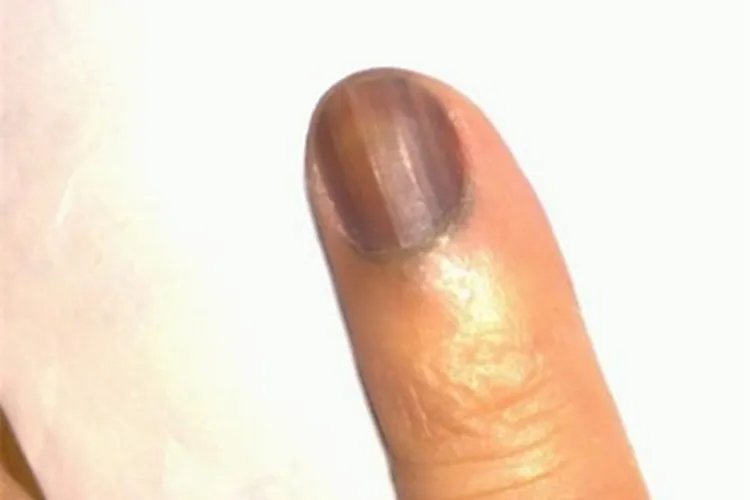 黑素瘤手指甲斑图片