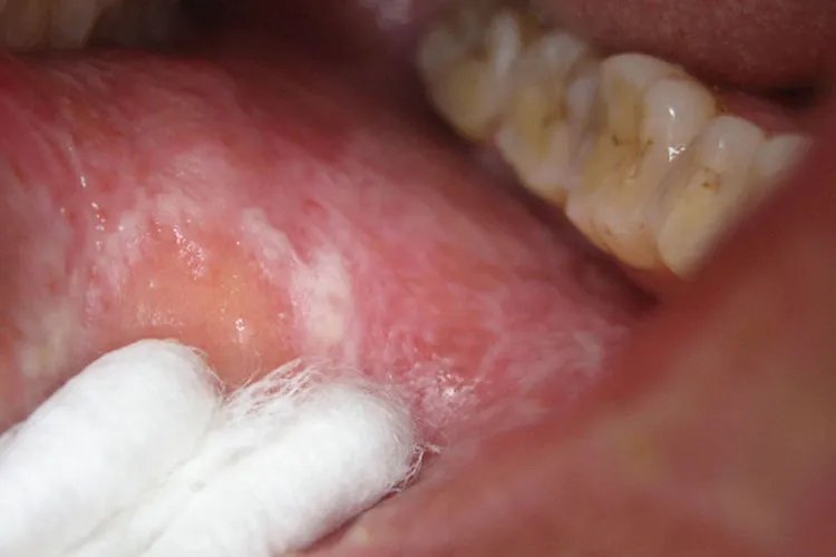 扁平苔藓的症状图片