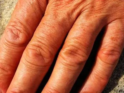 米索前列醇片吃了后手心痒是怎么回事