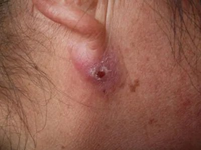 皮脂腺囊肿肿块图片