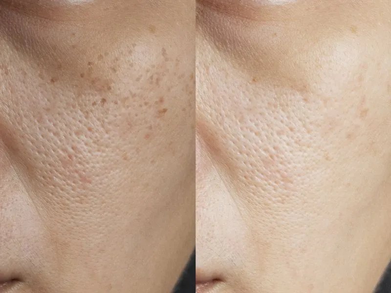 色斑形成的原因