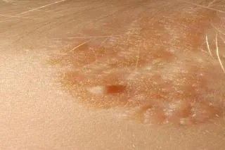 皮脂腺痣图片长什么样