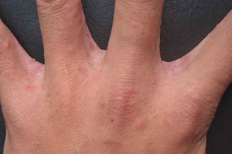 疥是什么皮肤病图片大全