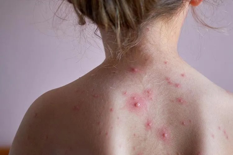 起水痘是什么样的图片