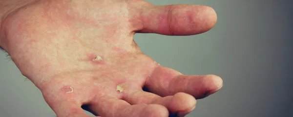 手指上起小水泡怎么回事