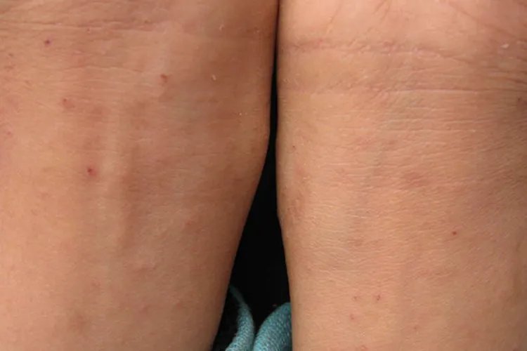 疥是什么皮肤病图片大全