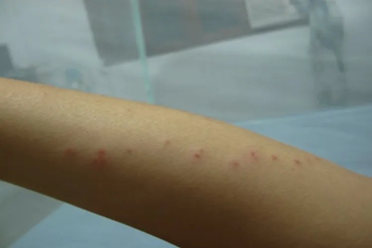 跳蚤咬了是什么样子图