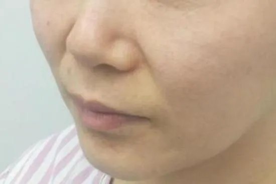 苹果肌是哪个部位