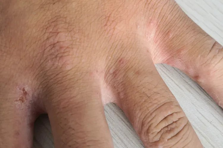 疥是什么皮肤病图片大全