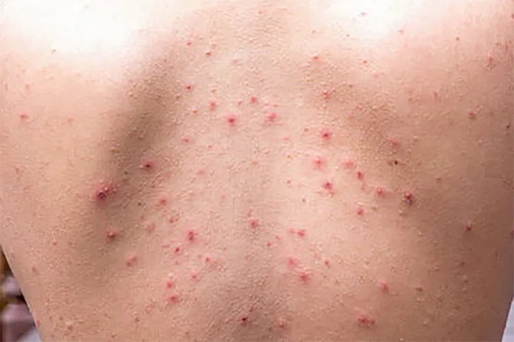 跳蚤咬了是什么样子图