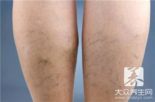 青筋暴起应该怎么治疗