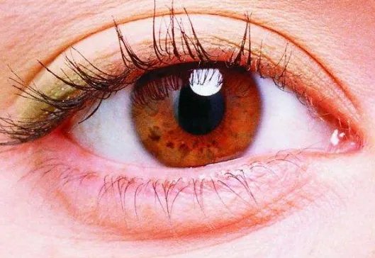 做双眼皮开眼角永久吗