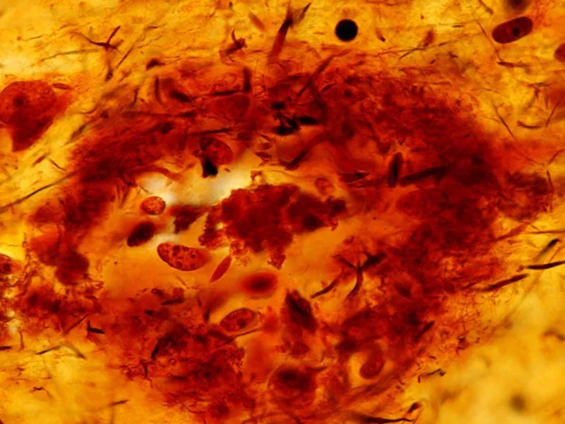 单纯疱疹病毒性脑炎的症状