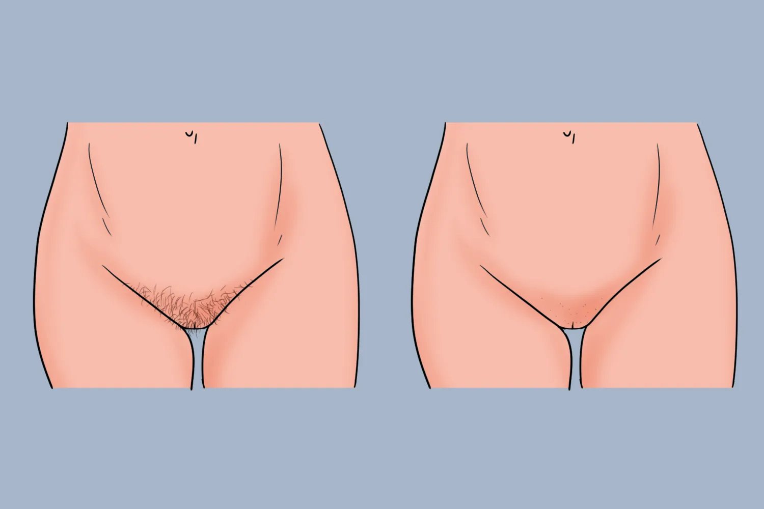 阴部脱毛效果图