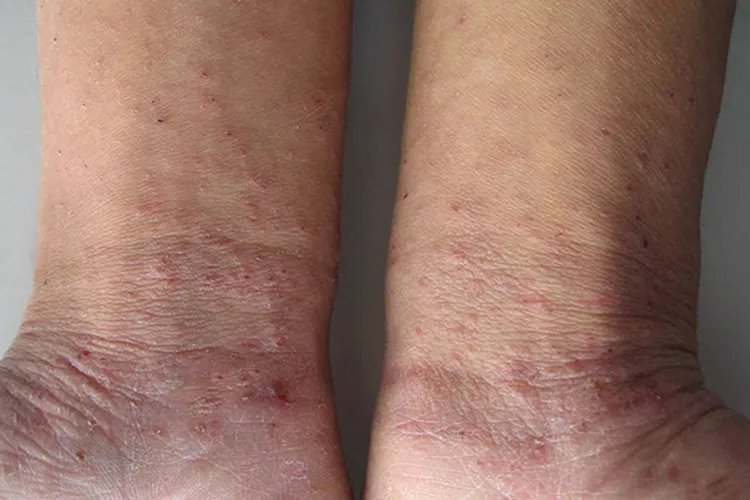 疥是什么皮肤病图片大全