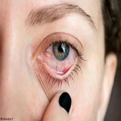 结膜炎注意事项有哪些