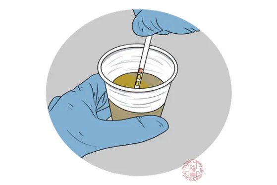 尿蛋白偏高是怎么回事