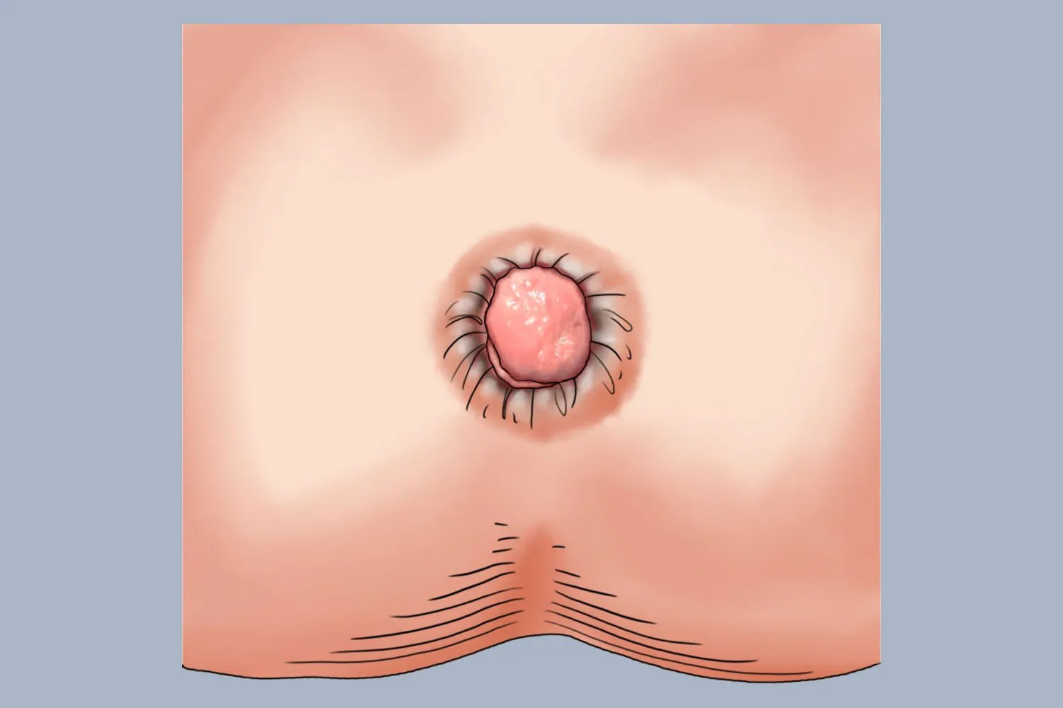 女性痔疮是什么样子的图片