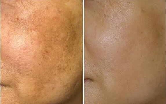 老年斑图片对比