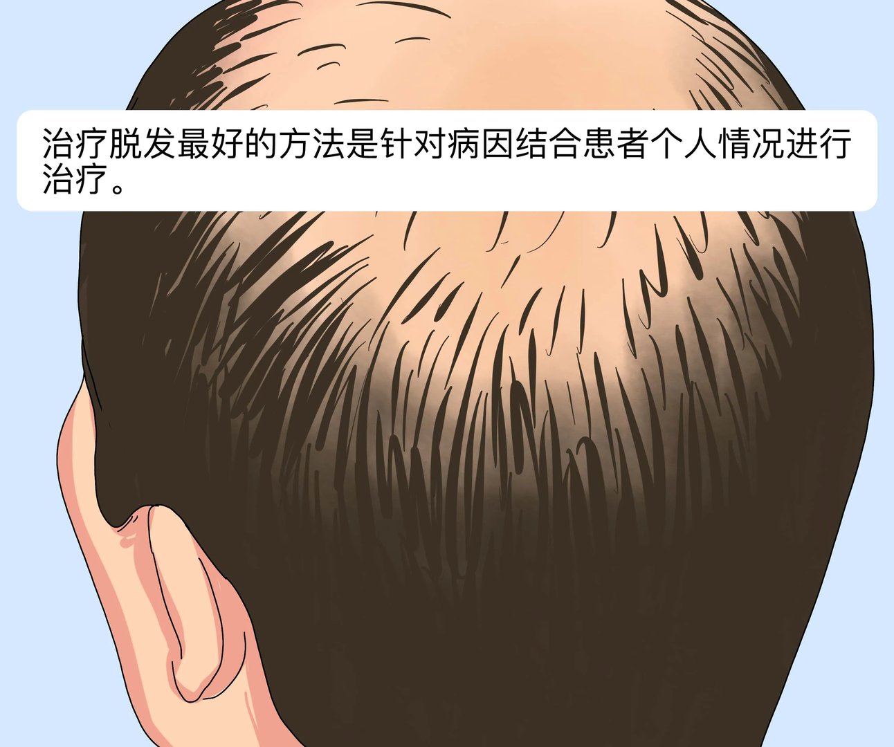 治脱发最好的方法