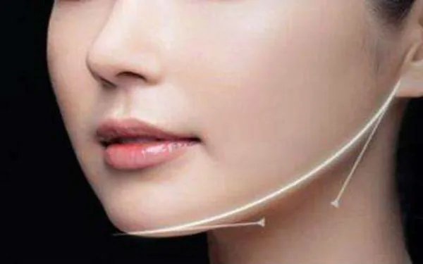 下巴整容怎么整的