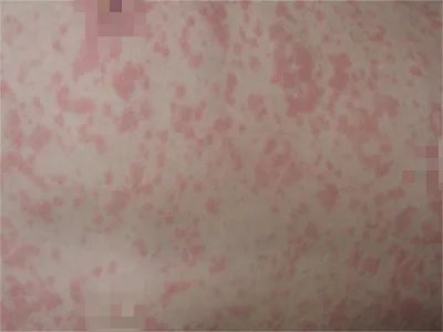 典型麻疹出疹期症状图片