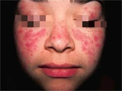 系统性红斑狼疮红斑图片