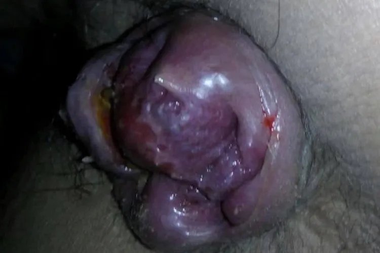 痔疮是长什么样子的