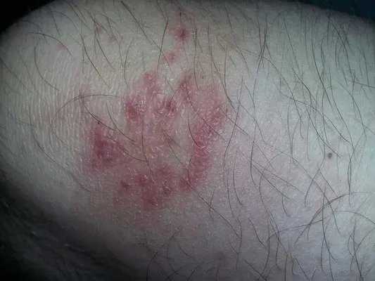 烫发药水过敏是什么症状?