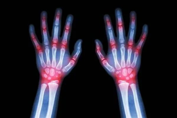 退行性骨关节炎有什么危害