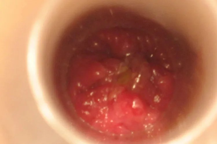 环切术后水肿严重图片