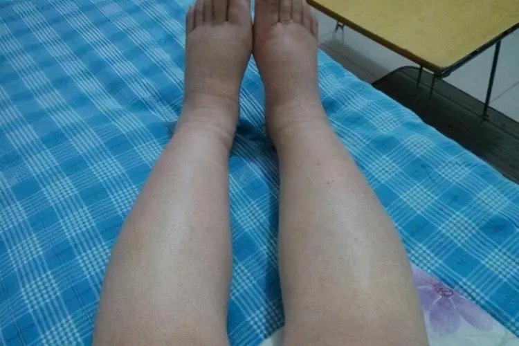 肝腹水的早期症状表现有哪些图片