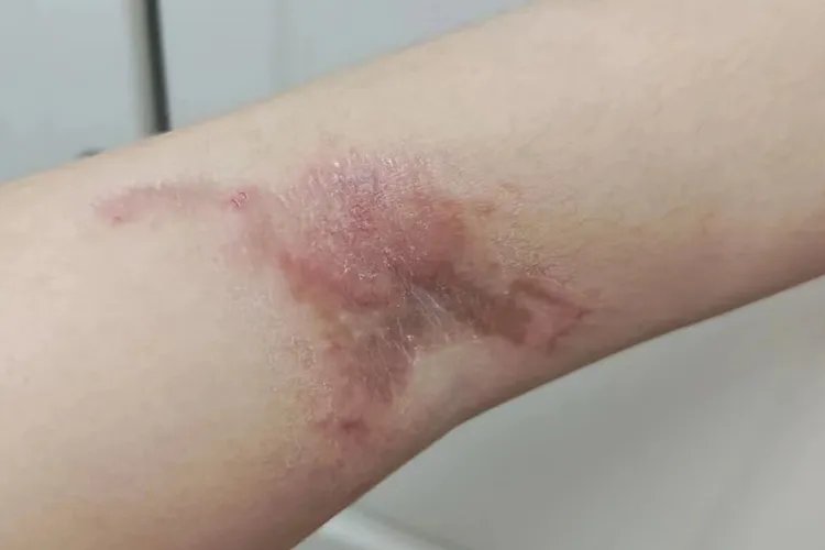 被隐翅虫咬后恢复过程图