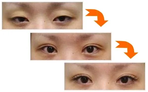 开眼角和割双眼皮多少钱