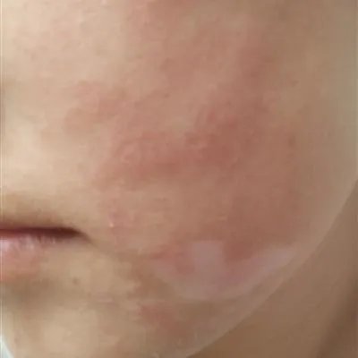 一扫光治疗湿疹怎么样