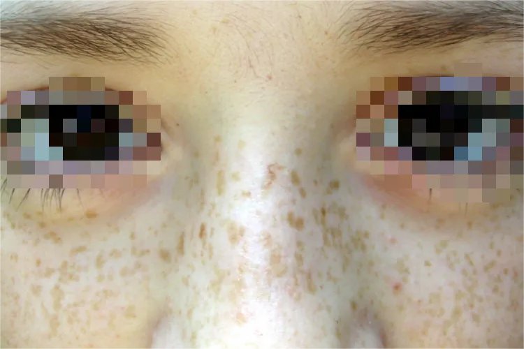 皮肤各种斑的图片介绍