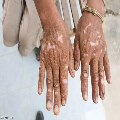 白癜风应该如何治疗