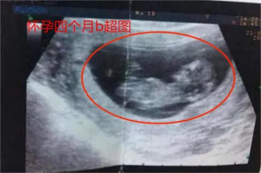 怀孕四个月b超图