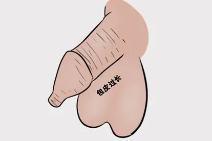 包皮过长的图片