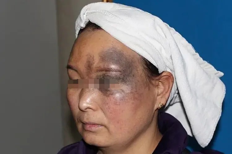 皮肤各种斑的图片介绍