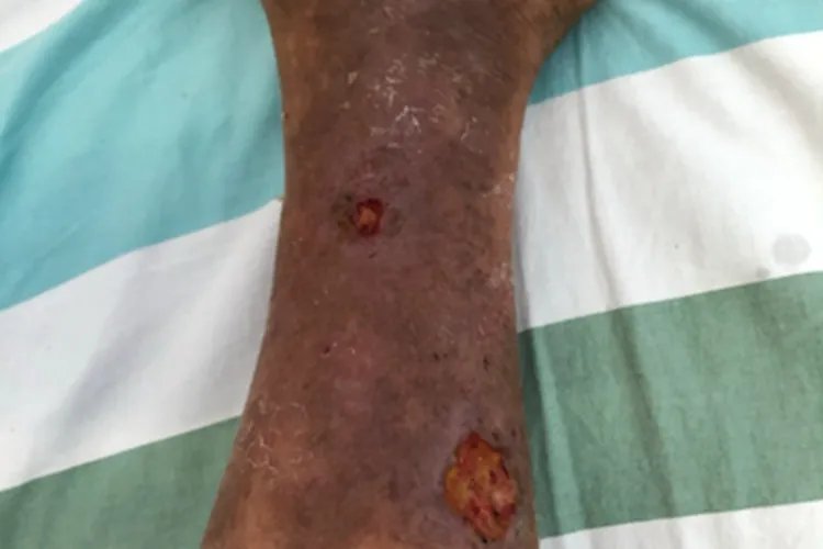 下肢静脉曲张小腿症状图片