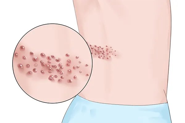 疱疹吃什么药最快能治好