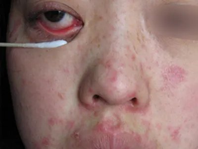 典型麻疹出疹期症状图片