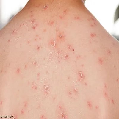 病毒性疣用什么药膏擦