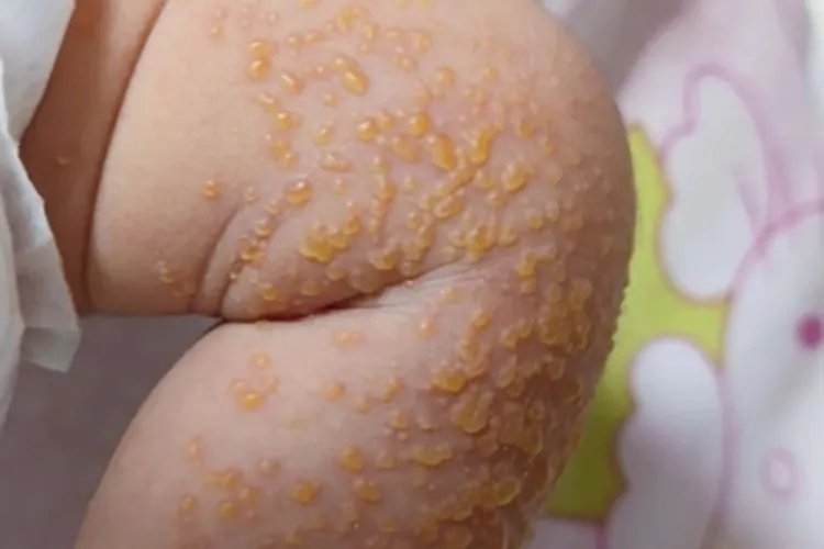 脓疱疮症状图片